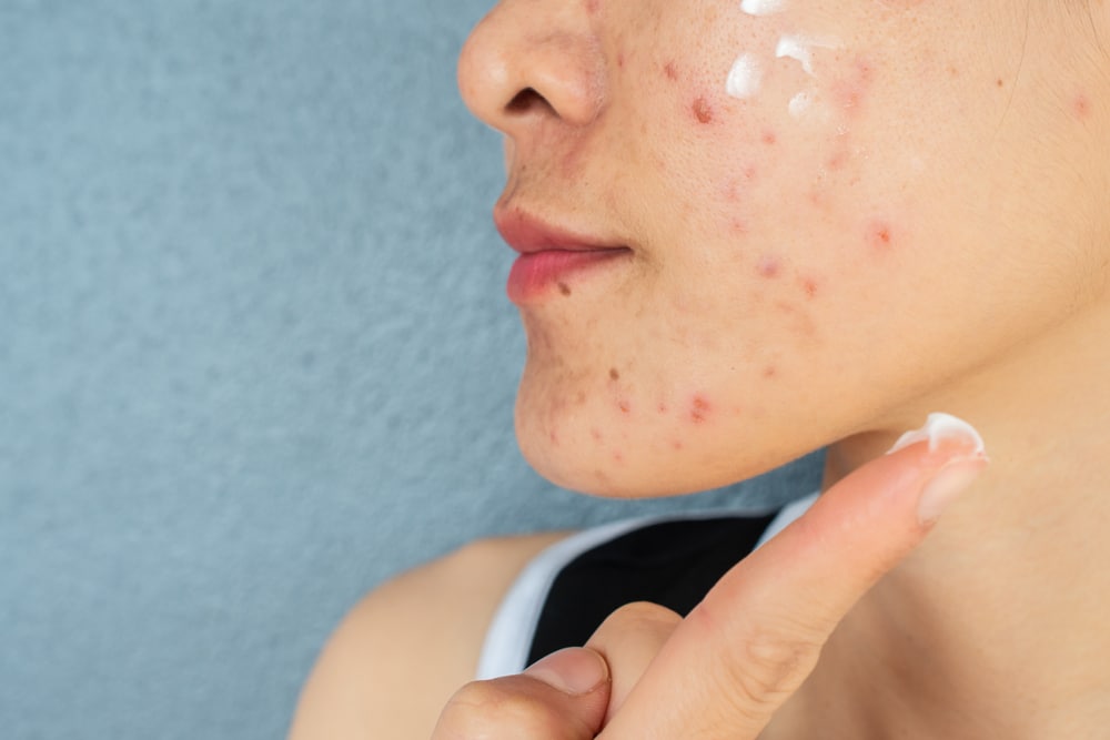 tratamiento y consejos para el acne