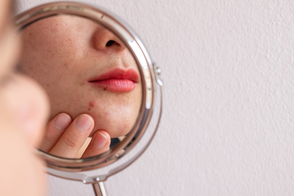 causas del acne